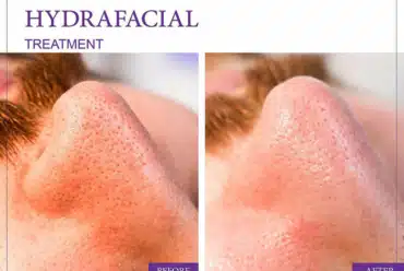 HydraFacial and Microdermabrasion
