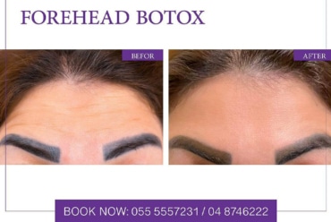 Wrinkles Treatment (Botox, Dysport)