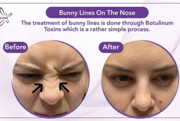 Bunny Lines on the Nose
