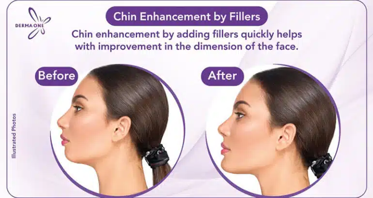 Chin Enhancement by Fillers