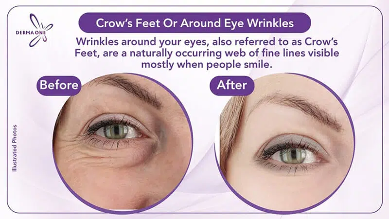 Crow Feet - Around Eye Wrinkles in dubai -derma one medical center
