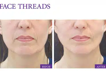 Mini Face Lifting by Cosmetic Threads