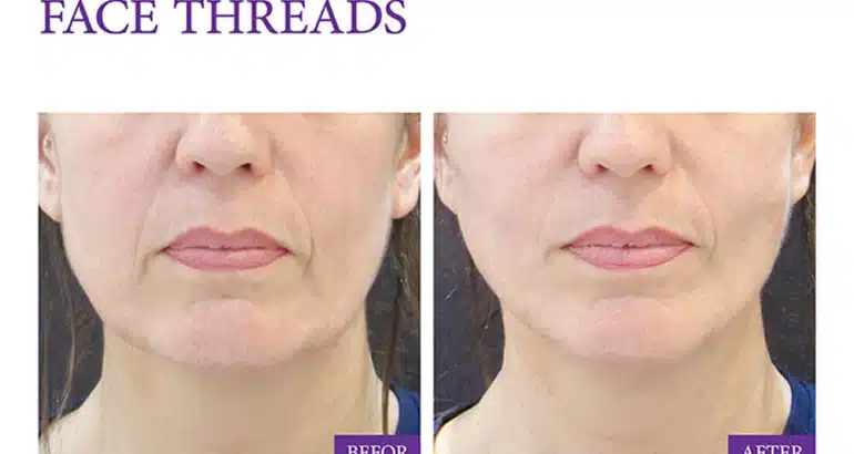 Mini Face Lifting by Cosmetic Threads
