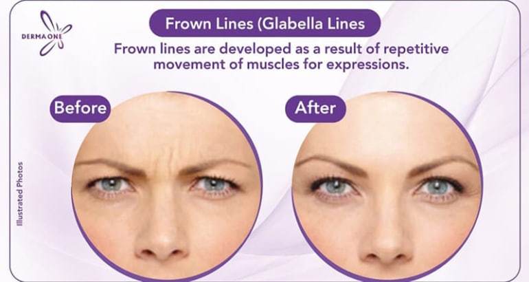 Frown Lines (Glabella Lines)