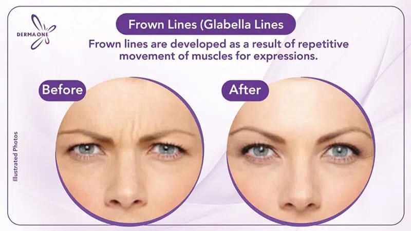 Frown Lines (Glabella Lines)