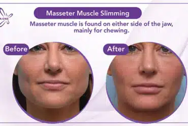 Masseter Muscle Slimming