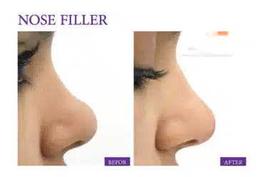 Nose Straightening by Fillers or Thread