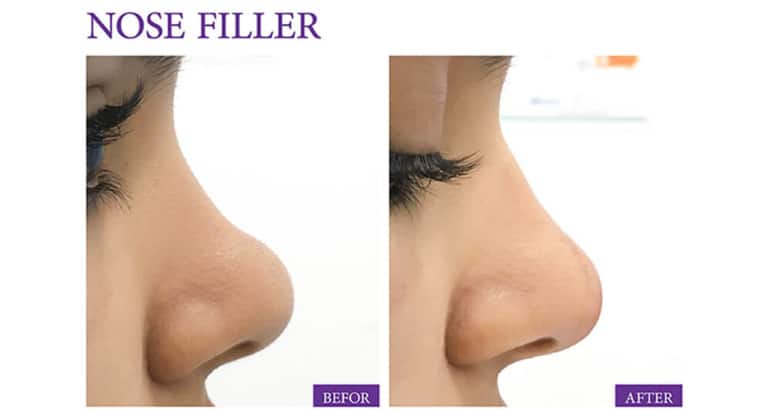Nose Straightening by Fillers or Thread