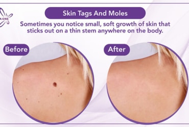 Skin Tags and Moles