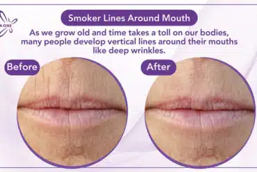 Smoker Lines Around Mouth