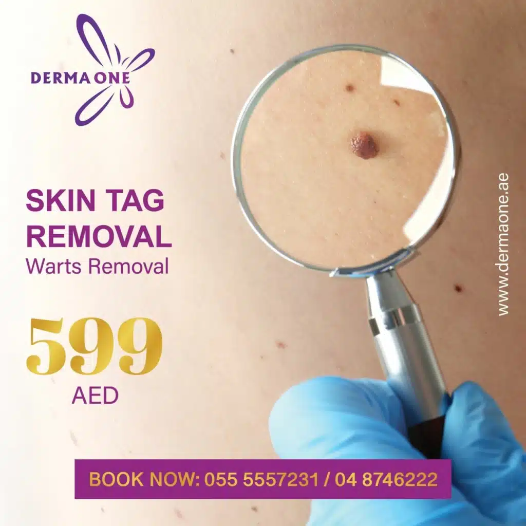 Skin tag Removal dubai offers 2023
