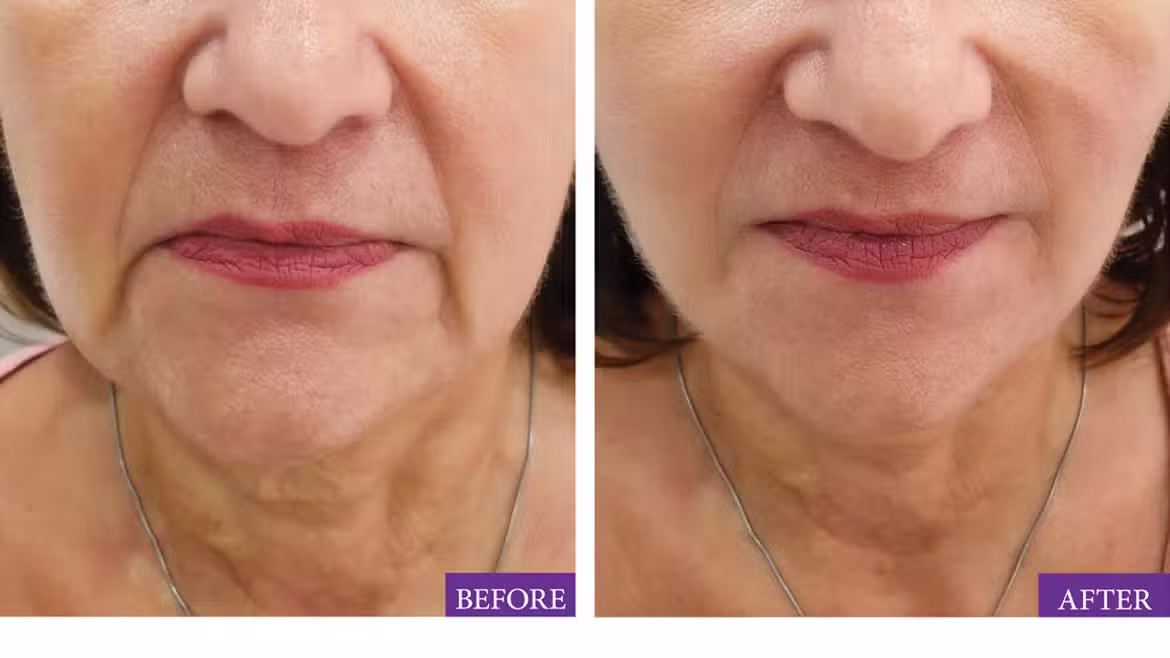 Can Botox Lift Your Face?