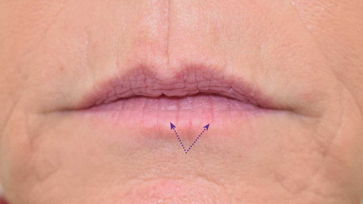 Deos Botox Work for Wrinkles Around Mouth/Lips?