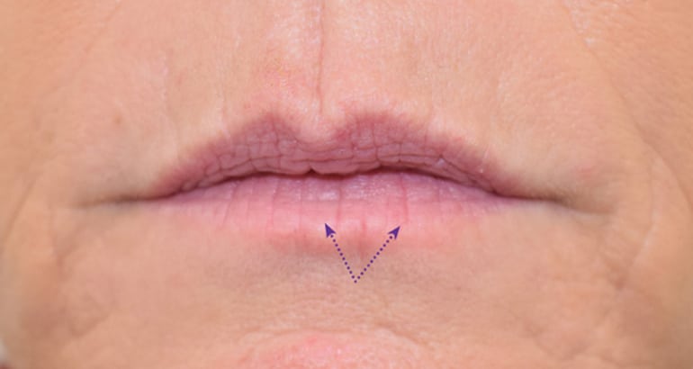 Deos Botox Work for Wrinkles Around Mouth/Lips?