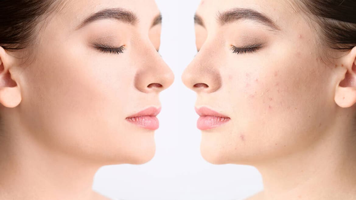 Unveiling the Science of Laser Scar Treatment