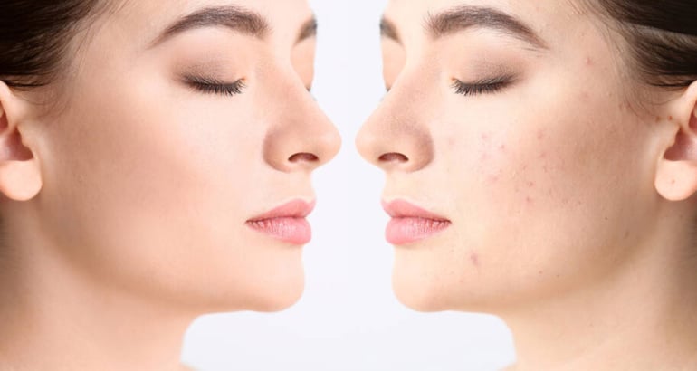 Unveiling the Science of Laser Scar Treatment in Dubai