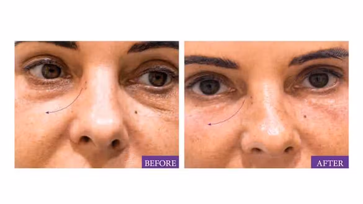 Under Eye Wrinkles : Choosing Between Botox and Fillers