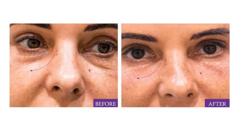 Under Eye Wrinkles Dubai: Choosing Between Botox and Fillers