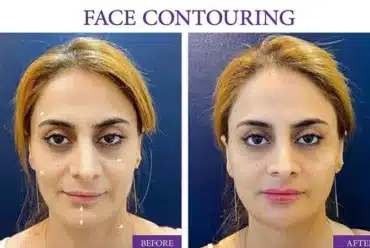 Filler for Face Contouring and Augmenting
