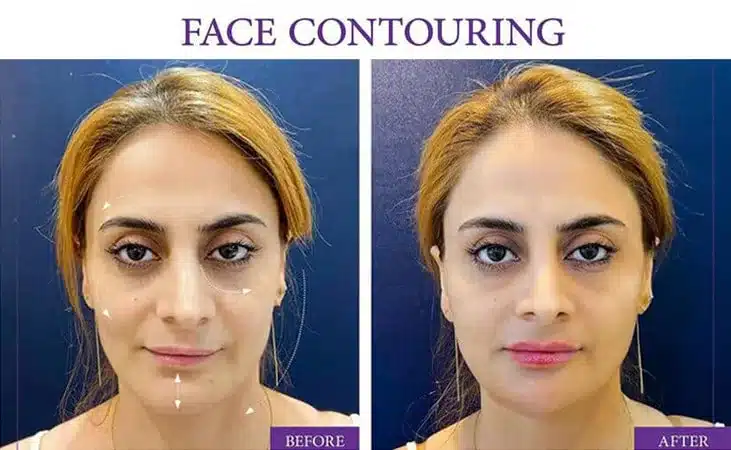Enhance Your Features through Non-surgical Facial Contouring