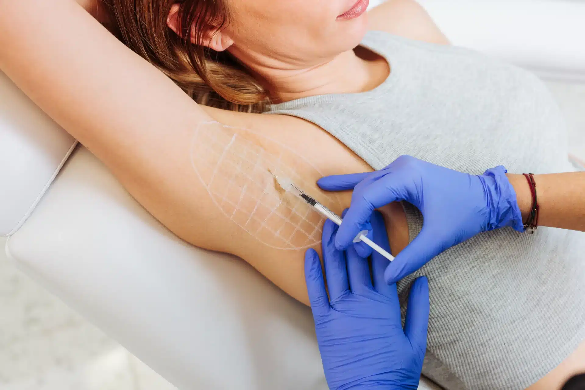 underarm botox