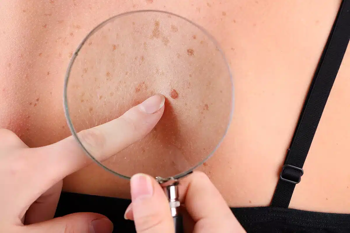 Skin Tag Removal in Dubai: Effective And Pain-Free Options