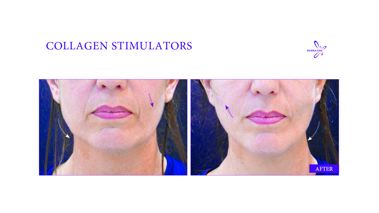 Rejuvenate Your Skin with Juvederm Volite