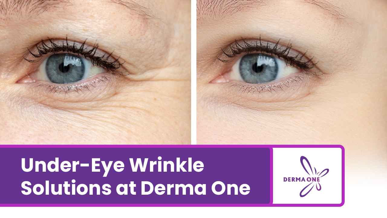 Under-Eye Wrinkle Solutions at Derma One