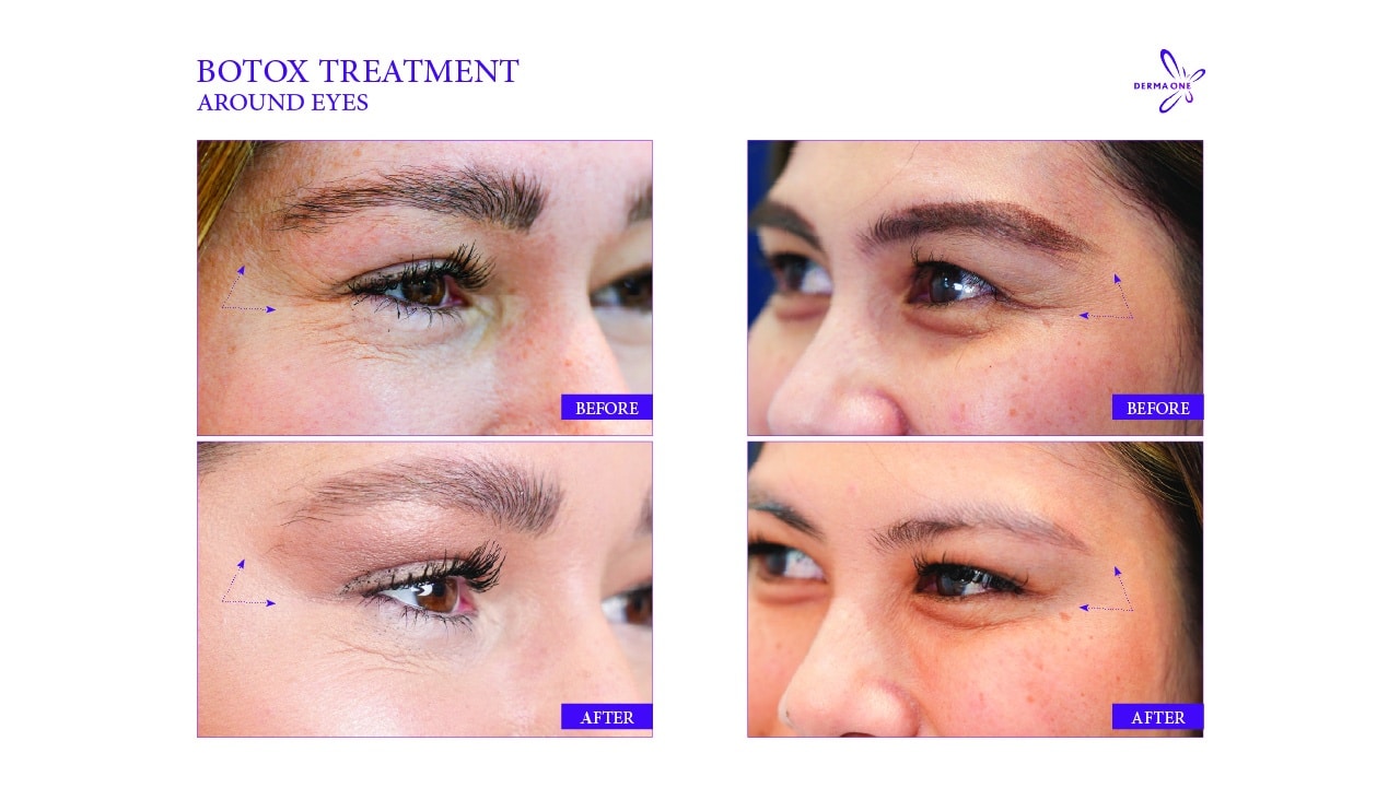 BOTOX TREATMENT around eyes