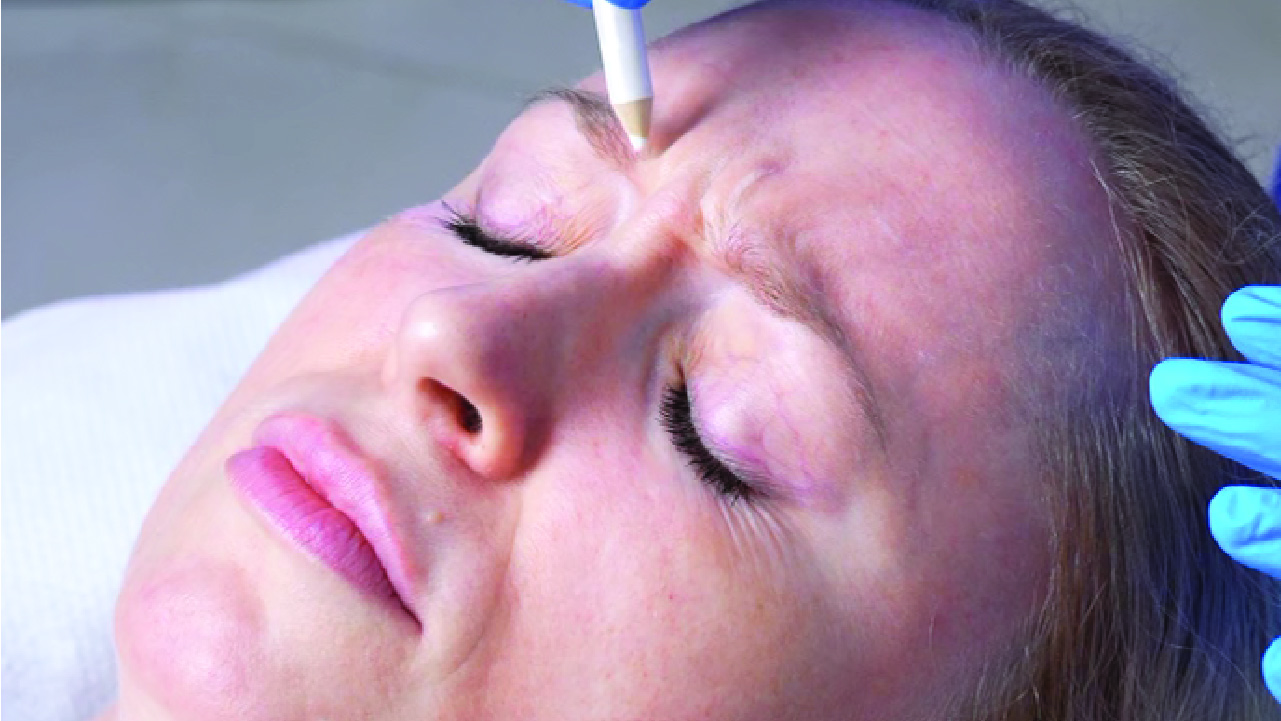 What Should I Do if My Botox Results Look Uneven?