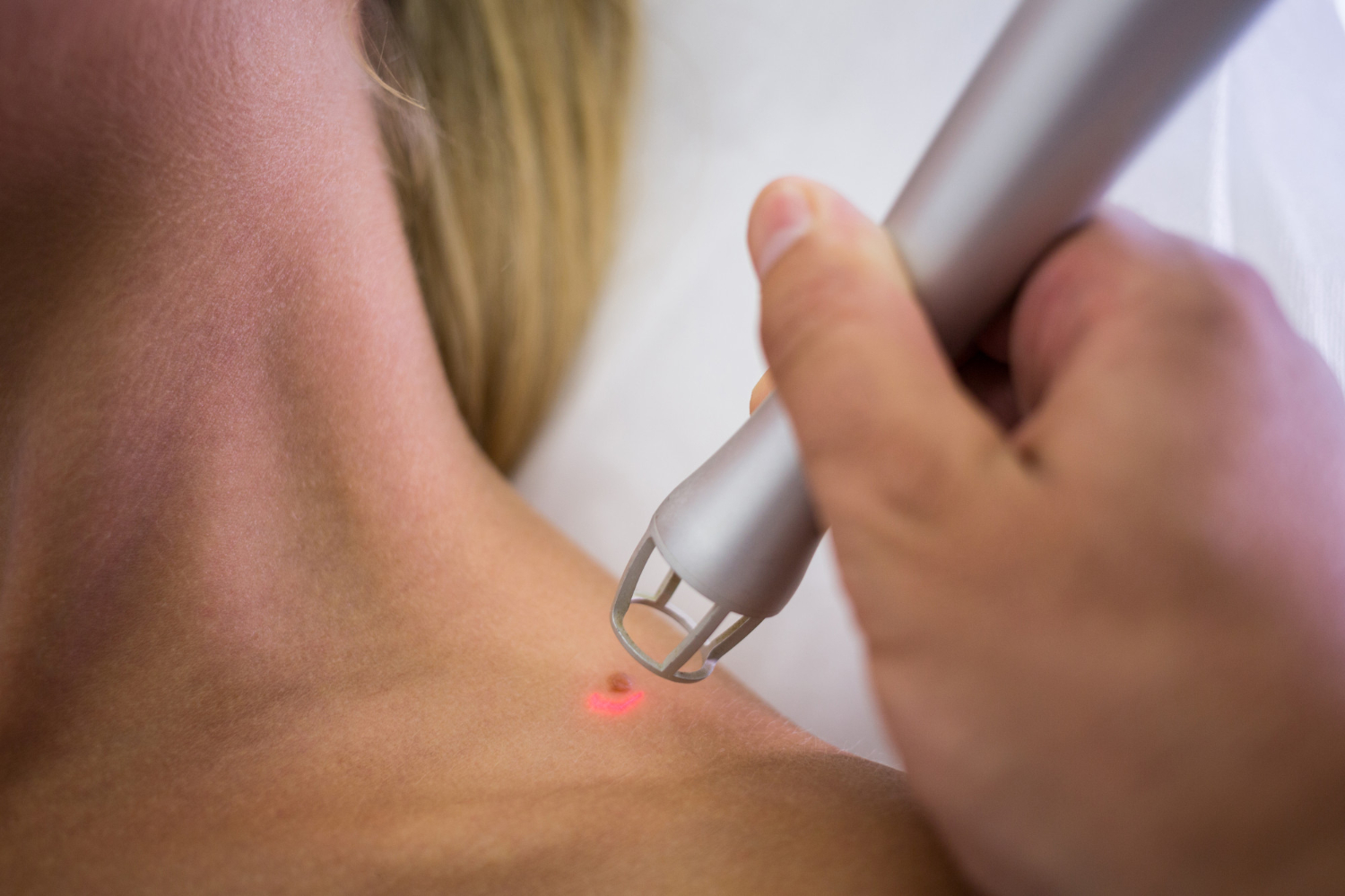 Skin Tag Removal Aftercare Power Tips For A Successful Recovery