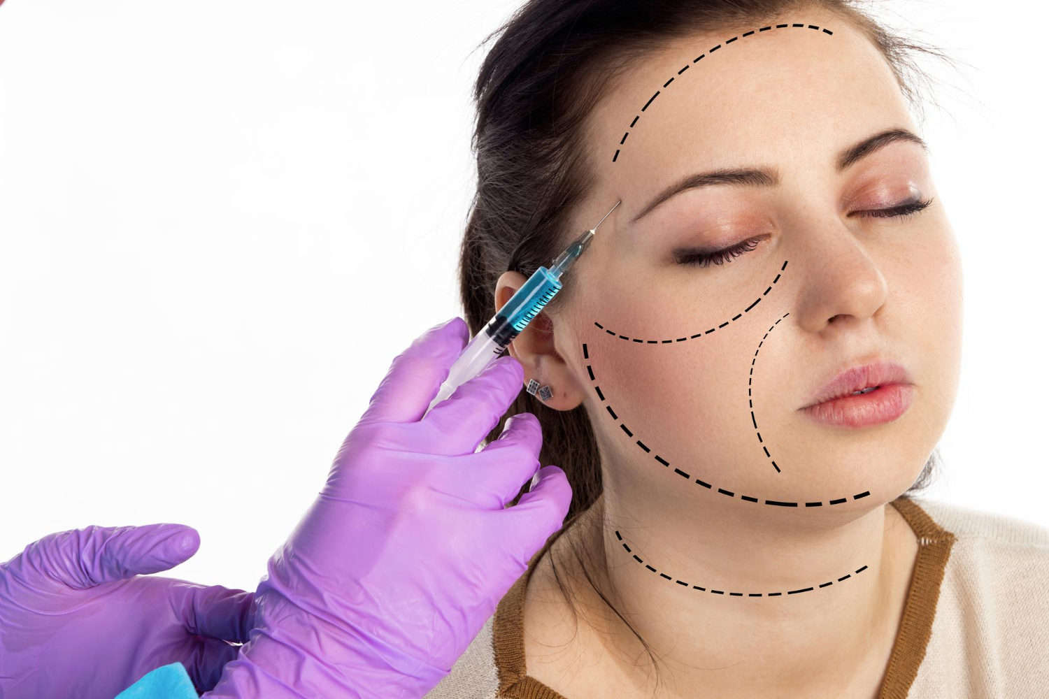 Your Guide to Sculptra® for Facial Rejuvenation