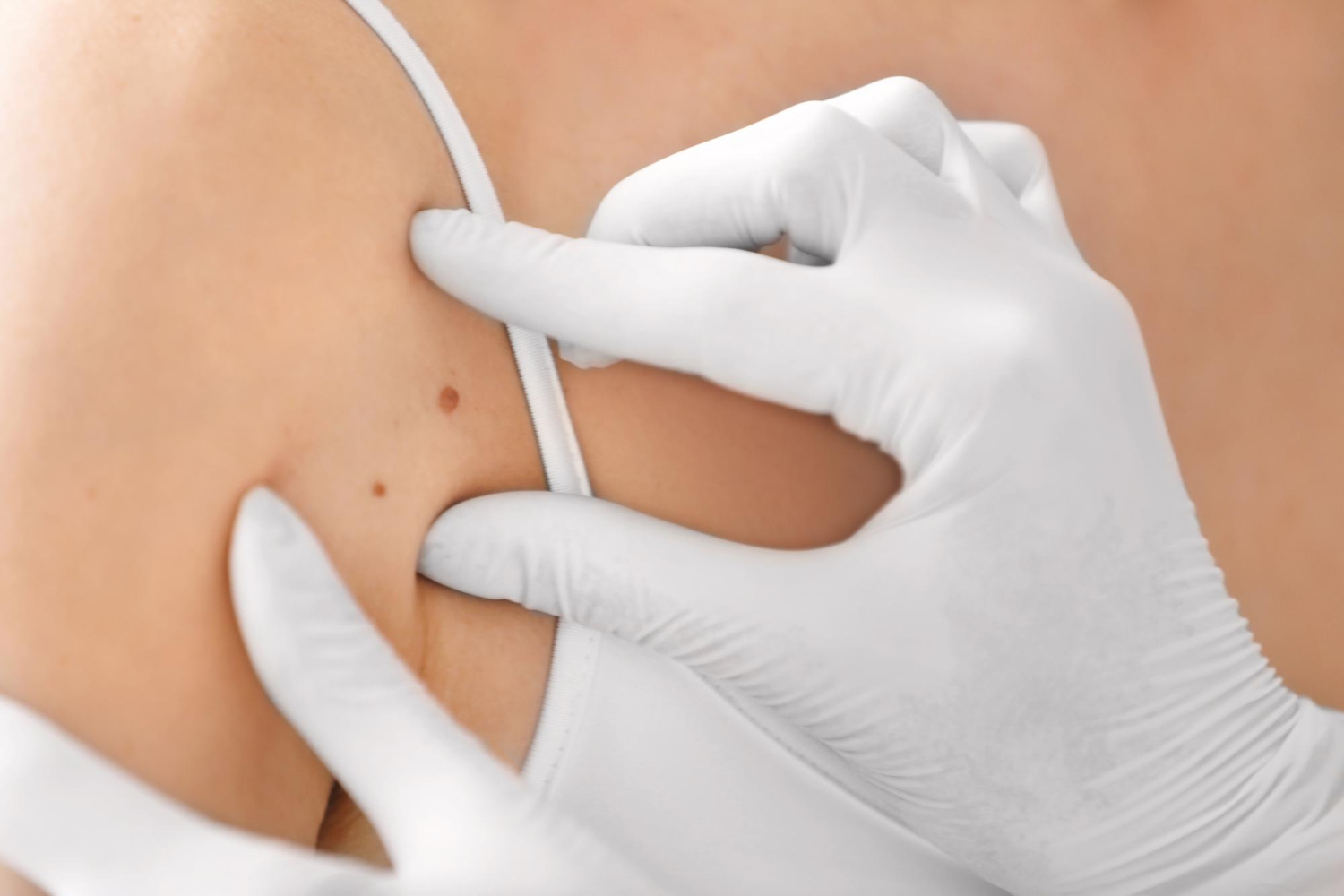 What Is the Best Method for Skin Tag Removal?