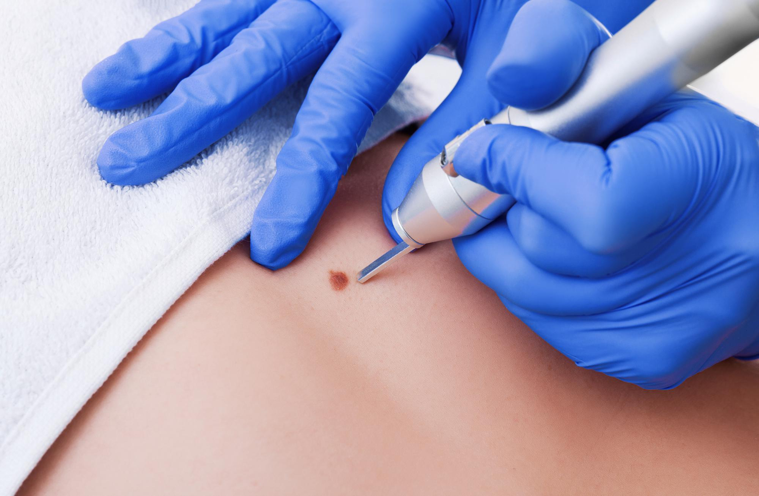 Your Expert Skin Tag Removal Guide: Causes, Options, and Aftercare